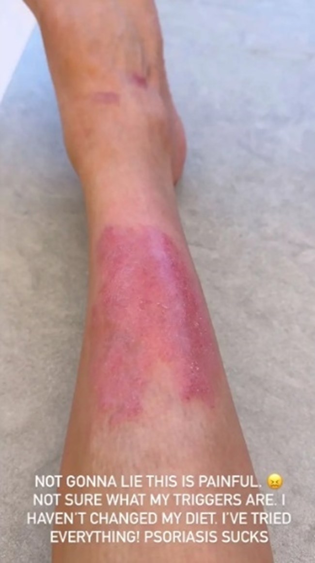 Η Κιμ Καρντάσιαν αποκαλύπτει την επώδυνη μάχη με το χρόνιο νόσημα και αποδομεί την "τέλεια εικόνα" της