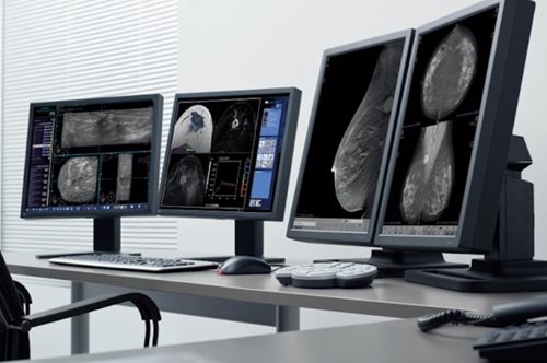 ΙΑΤΡΟΠΟΛΙΣ: Η Τεχνητή Νοημοσύνη και στη μάχη κατά του καρκίνου μαστού