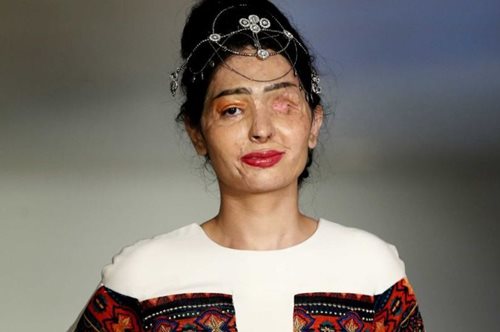 «Κάντε έρωτα, όχι ουλές». Μια νεαρή γυναίκα βοηθάει όσες επέζησαν από επίθεση με οξύ στην Ινδία