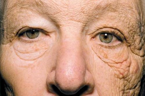 Η φωτογραφία που δείχνει με σοκαριστικό τρόπο τις βλαβερές επιπτώσεις του ηλίου στην επιδερμίδα 