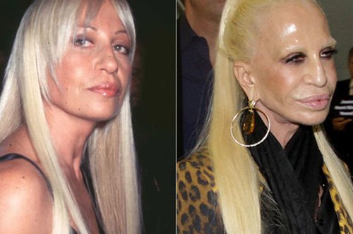 Τι πήγε στραβά; Οι 15 πιο αποτυχημένες πλαστικές των celebrities