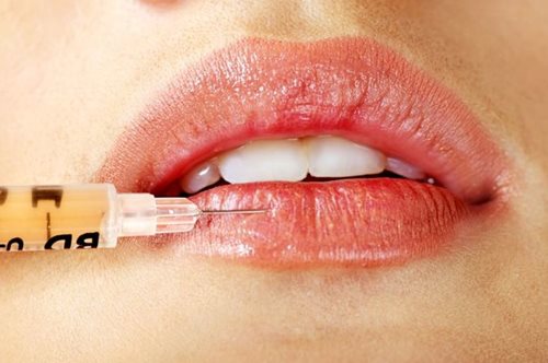 «Μιλούσα σαν πάπια»: Μια Ελληνίδα μπλόγκερ περιγράφει την εμπειρία της με το γέμισμα των χειλιών  