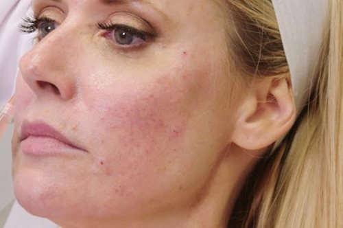 Η πιο «ανατριχιαστική» μέθοδος αντιγήρανσης είναι η αποτελεσματικότερη τάση της εποχής