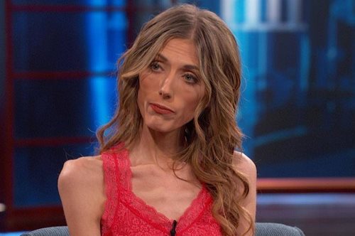 «Θέλω να χάσω κι άλλο»: Η ανορεξική γυναίκα που ζυγίζει 34 κιλά κάνει μια σοκαριστική δήλωση  