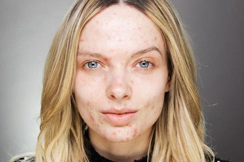 Η καμπάνια που ενθαρρύνει τις γυναίκες με ακμή να ανεβάσουν φωτογραφίες χωρίς μέικ απ