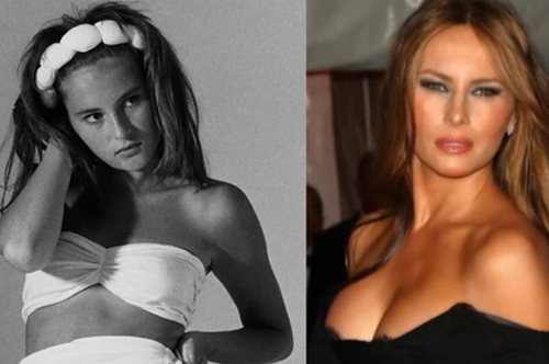 Πριν και μετά: Οι πλαστικές των 12.000 λιρών που μεταμόρφωσαν τη Μελάνια 