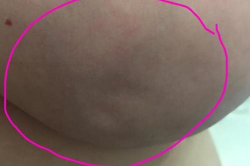 Πώς μια γυναίκα αντιλήφθηκε τον καρκίνο στο στήθος της