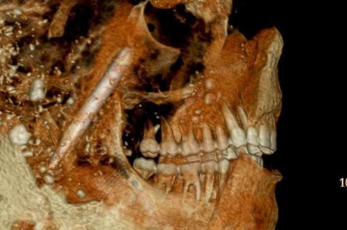 Οι Αρχαίοι Ρωμαίοι δεν χρειάζονταν οδοντίατρο, εξαιτίας ενός φαγητού που δεν έτρωγαν