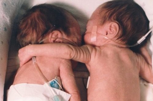 Τα πρόωρα δίδυμα που αγκαλιάστηκαν στη θερμοκοιτίδα σώζοντας το ένα τη ζωή του άλλου