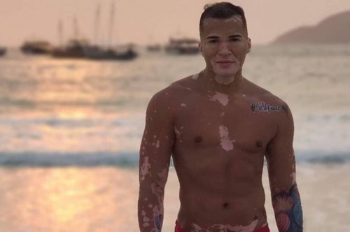 «Νόμιζα ότι η ζωή μου είχε τελειώσει»: H εξομολόγηση του 37χρονου influencer που πάσχει από λεύκη