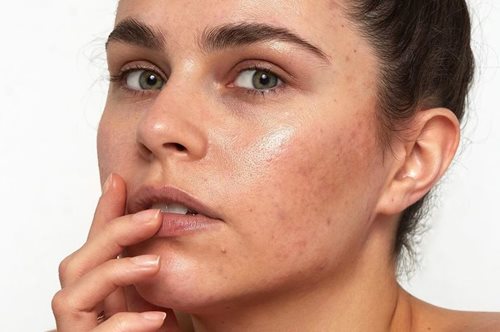 Η influencer που αγνοεί τα φίλτρα του Instagram και μας δείχνει το γεμάτο ατέλειες δέρμα της