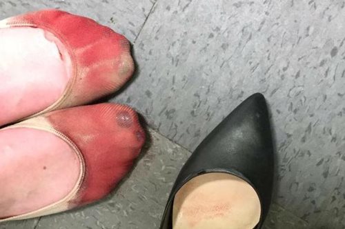 Τα καταματωμένα πόδια μιας σερβιτόρας από τα τακούνια στην πιο viral φωτογραφία