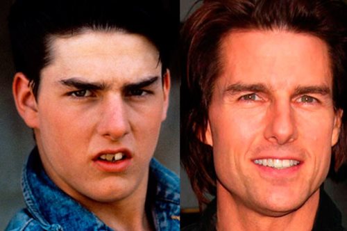 14 διάσημοι με άσχημα δόντια (πριν την ορθοδοντική)