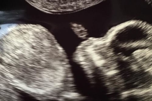 Kαι νέο μωρό Καρντάσιαν - Ο υπέρηχος που το αποκάλυψε