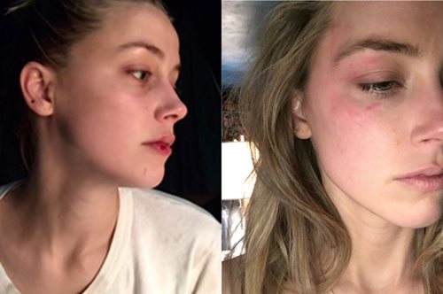 Με μώλωπες και σκισμένα χείλη η Χερντ στο πρώτο εξώφυλλο μετά το χωρισμό με τον Τζόνι Ντεπ