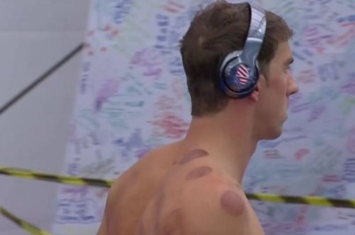 Γιατί ο Μάικλ Φελπς και άλλοι αθλητές έχουν μεγάλους κόκκινους μώλωπες στο σώμα τους;