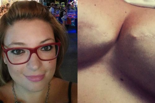 Η φωτογραφία της Ελληνίδας με τη μαστεκτομή που μας δείχνει πώς είναι ο καρκίνος