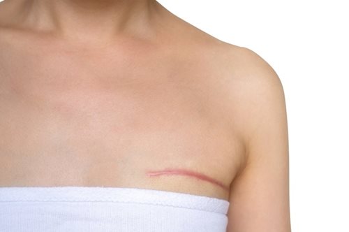 Aποκατάσταση στήθους μετά τη μαστεκτομή