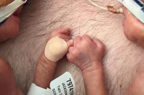 Πρόωρα δίδυμα μωρά κρατιούνται χέρι χέρι και γίνονται viral