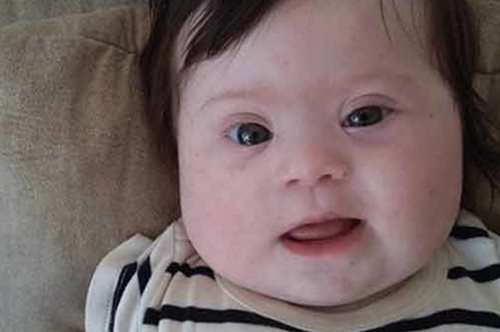 Η κόρη μου Λουίζ έχει ένα παραπάνω χρωμόσωμα