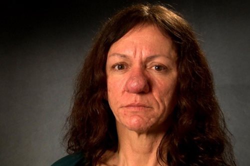 Απόλυτη μεταμόρφωση. Η πλαστική στη μύτη τής άλλαξε τη ζωή