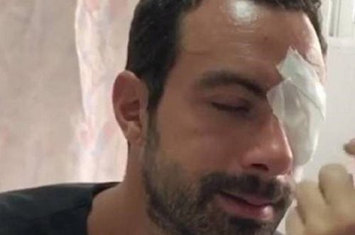 Το ατύχημα του Σάκη Τανιμανίδη στο Survivor. Πως βρέθηκε με μπανταρισμένο μάτι