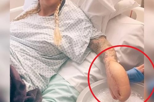 Η γυναίκα με το χέρι-καρχαρία: Οι γιατροί το ακρωτηρίασαν και το έραψαν μέσα στην κοιλιά - Βίντεο
