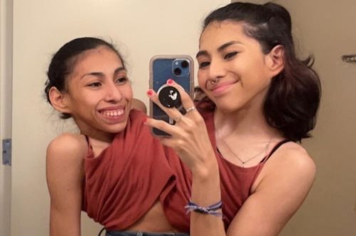 Σιαμαίες 22 ετών μιλούν για την ερωτική ζωή τους: 