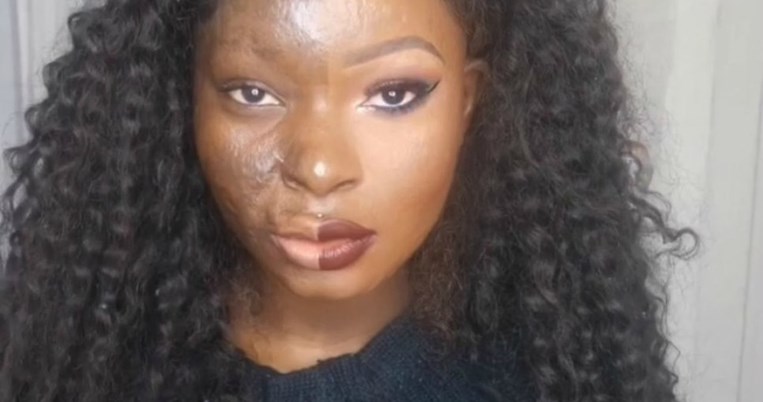 To θαύμα του μακιγιάζ μεταμορφώνει το πρόσωπο μιας γυναίκας που κάηκε στα 9 της χρόνια