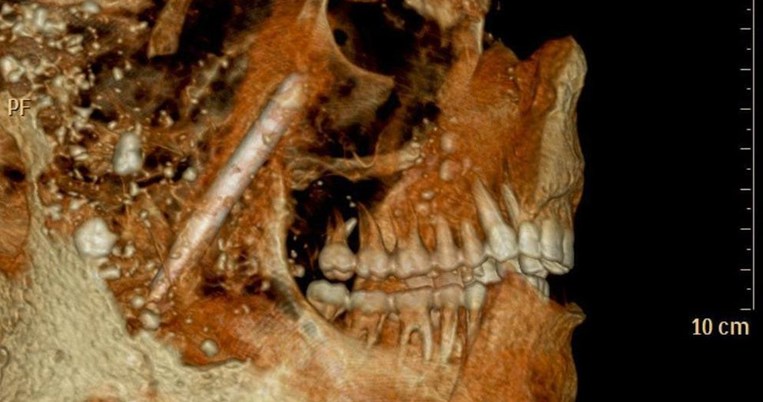 Οι Αρχαίοι Ρωμαίοι δεν χρειάζονταν οδοντίατρο, εξαιτίας ενός φαγητού που δεν έτρωγαν