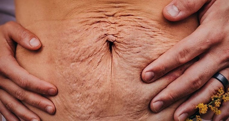 «Το μαλακό, ζαρωμένο δέρμα της κοιλιάς της φιλοξένησε για 18 μήνες τους τρεις καλύτερους φίλους μου»