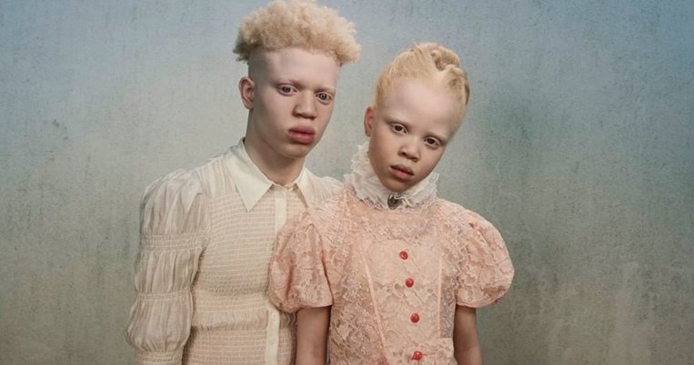 Αδερφάκια με αλμπινισμό κάνουν μόντελινγκ και πολεμούν το στίγμα: «Αλλάζουν τον ορισμό της ομορφιάς»