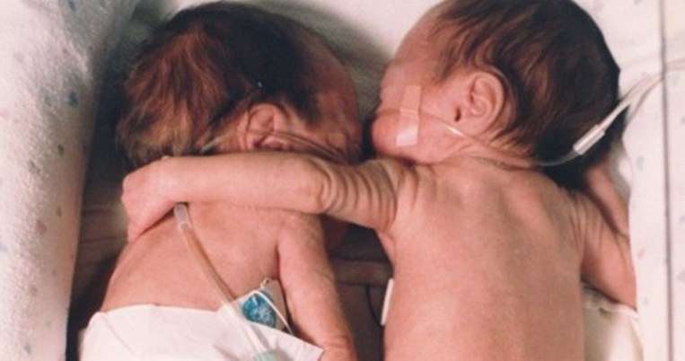 Τα πρόωρα δίδυμα που αγκαλιάστηκαν στη θερμοκοιτίδα σώζοντας το ένα τη ζωή του άλλου