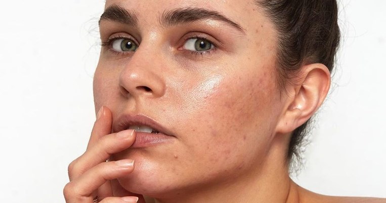 Η influencer που αγνοεί τα φίλτρα του Instagram και μας δείχνει το γεμάτο ατέλειες δέρμα της
