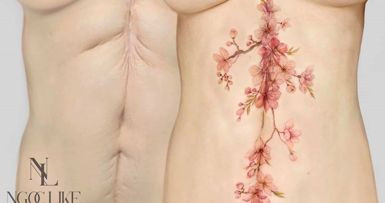 Tattoo artist μετατρέπει τις ουλές από επεμβάσεις και ατυχήματα σε ρομαντικά τατουάζ