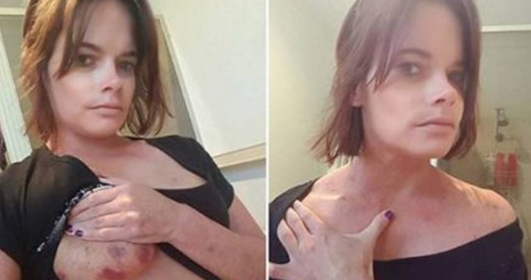 Γυναίκα που έπεσε θύμα βιασμού δημοσίευσε φωτογραφίες από τα τραύματά της