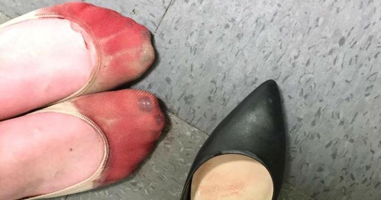 Τα καταματωμένα πόδια μιας σερβιτόρας από τα τακούνια στην πιο viral φωτογραφία