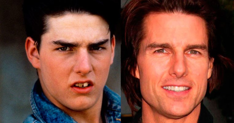 14 διάσημοι με άσχημα δόντια (πριν την ορθοδοντική)