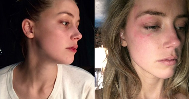 Με μώλωπες και σκισμένα χείλη η Χερντ στο πρώτο εξώφυλλο μετά το χωρισμό με τον Τζόνι Ντεπ