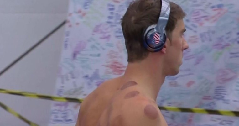 Γιατί ο Μάικλ Φελπς και άλλοι αθλητές έχουν μεγάλους κόκκινους μώλωπες στο σώμα τους;