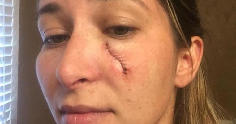 Το σοκ μιας γυναίκας όταν ένα σπυράκι εξελίχθηκε σε καρκίνωμα