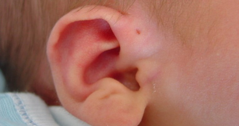 Γιατί πολλοί άνθρωποι γεννιούνται με μία τρύπα πάνω απο το αυτί τους;