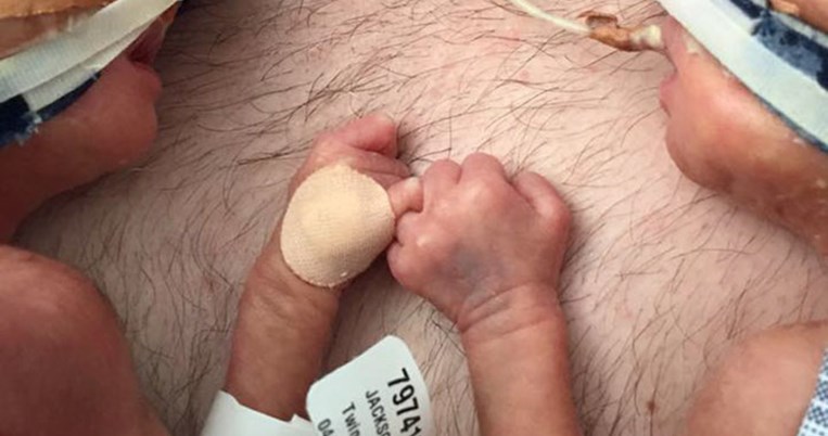 Πρόωρα δίδυμα μωρά κρατιούνται χέρι χέρι και γίνονται viral