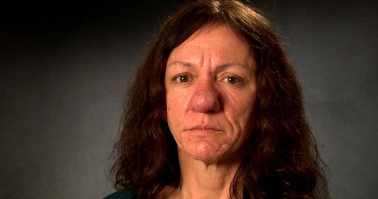 Απόλυτη μεταμόρφωση. Η πλαστική στη μύτη τής άλλαξε τη ζωή