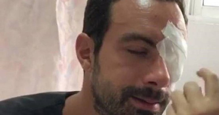 Το ατύχημα του Σάκη Τανιμανίδη στο Survivor. Πως βρέθηκε με μπανταρισμένο μάτι