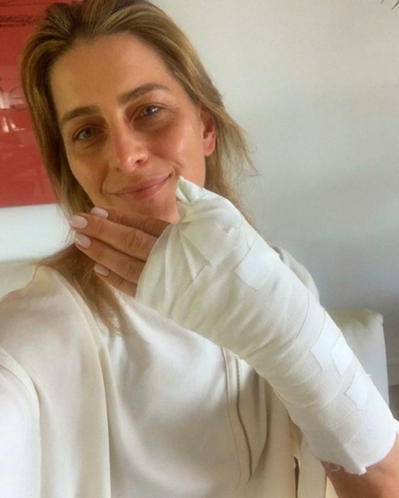 «Έχω ακόμα αντίχειρα»: Το ατύχημα της Τατιάνα Μπλάτνικ -Το χειρουργείο συγκόλλησης 