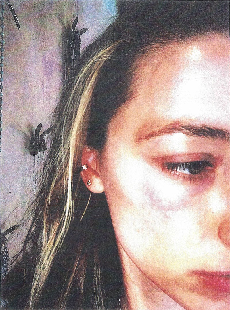 Οι εικόνες που μαρτυρούν ότι η Amber Heard έτρωγε ξύλο από τον Johnny Depp