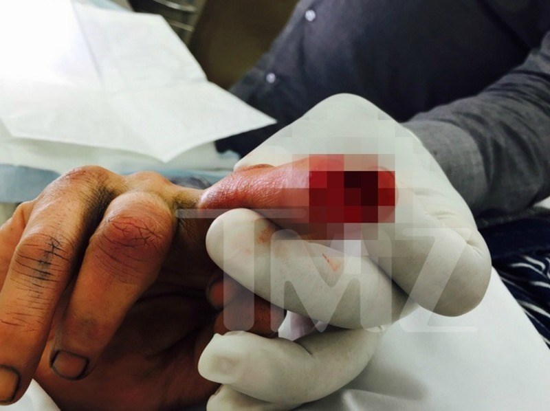 Νέες σοκαριστικές φωτογραφίες με το κομμένο δάχτυλο του Τζόνι Ντεπ σε ξέσπασμα βίας