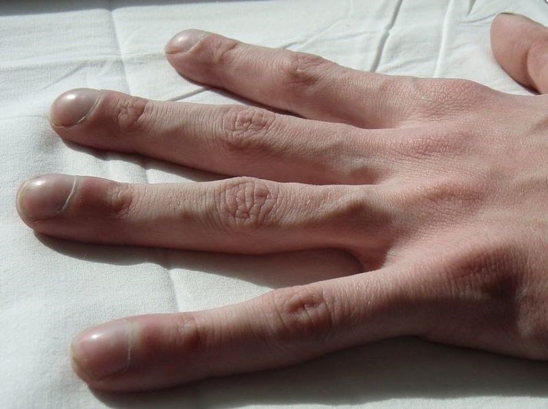 8 συμπεράσματα που βγάζει ένας γιατρός παρατηρώντας τα νύχια μας